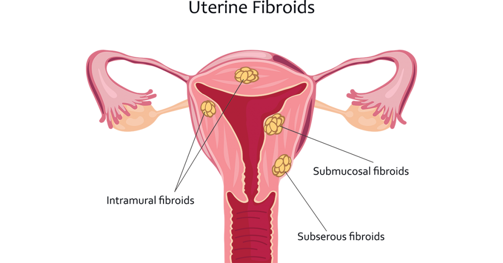 uterine fibroids images