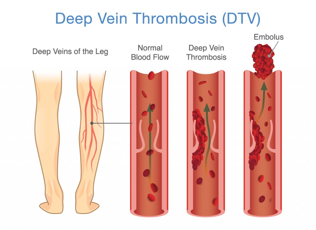 illustration of deep vein thrombosis; blog: DVT prevention
