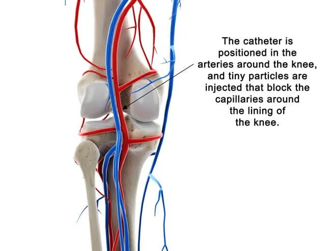 Step-by-step diagram of the GAE catheter procedure for knee pain treatment