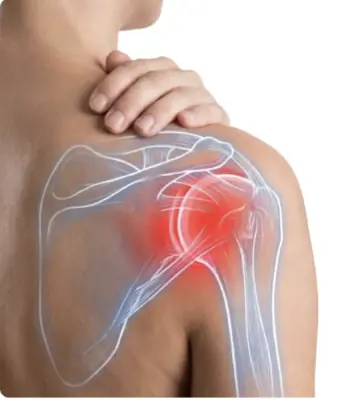 Anatomical illustration of a shoulder highlighting inflammation in the joint targeted by Shoulder TAME embolization