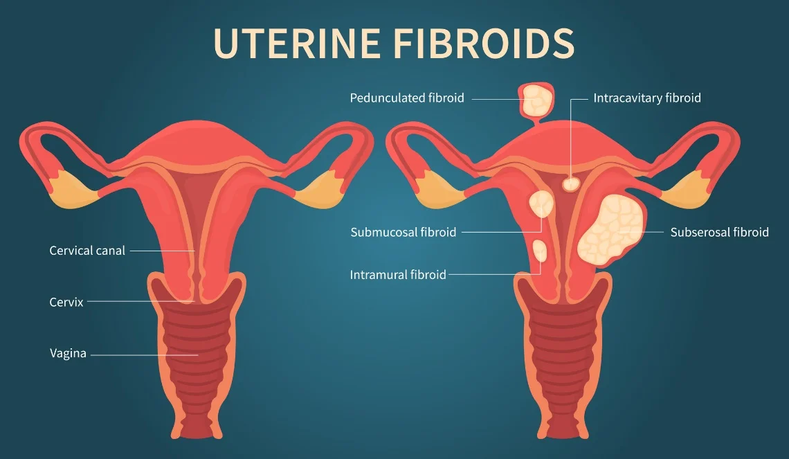 Diagram showing the different types of uterine fibroids including pedunculated, intracavitary, submucosal, subserosal, and intramural fibroids