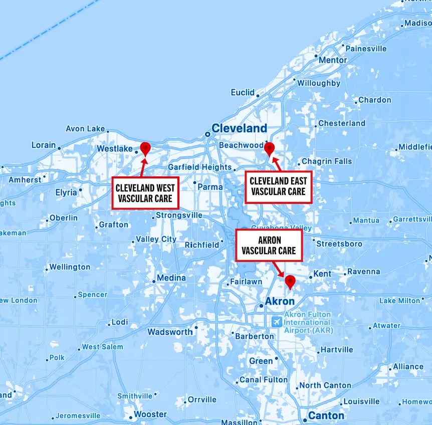 Map of Preferred Vascular Group locations in Northeast Ohio