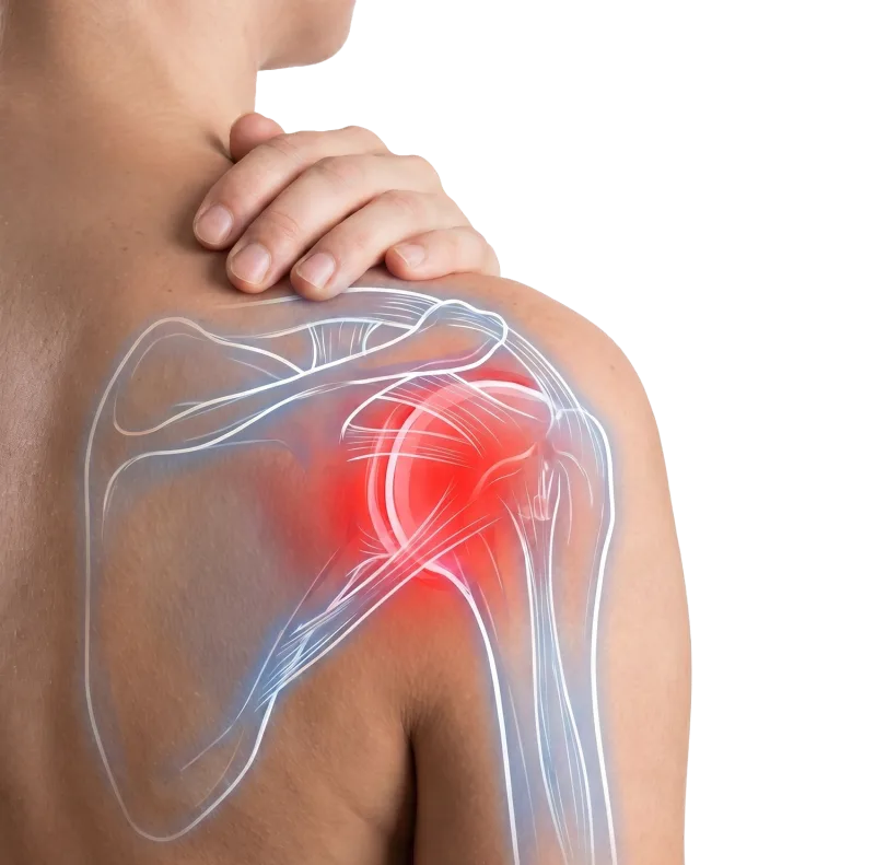 Diagram showing a catheter positioned in the arteries around the shoulder, delivering tiny particles during Shoulder TAME