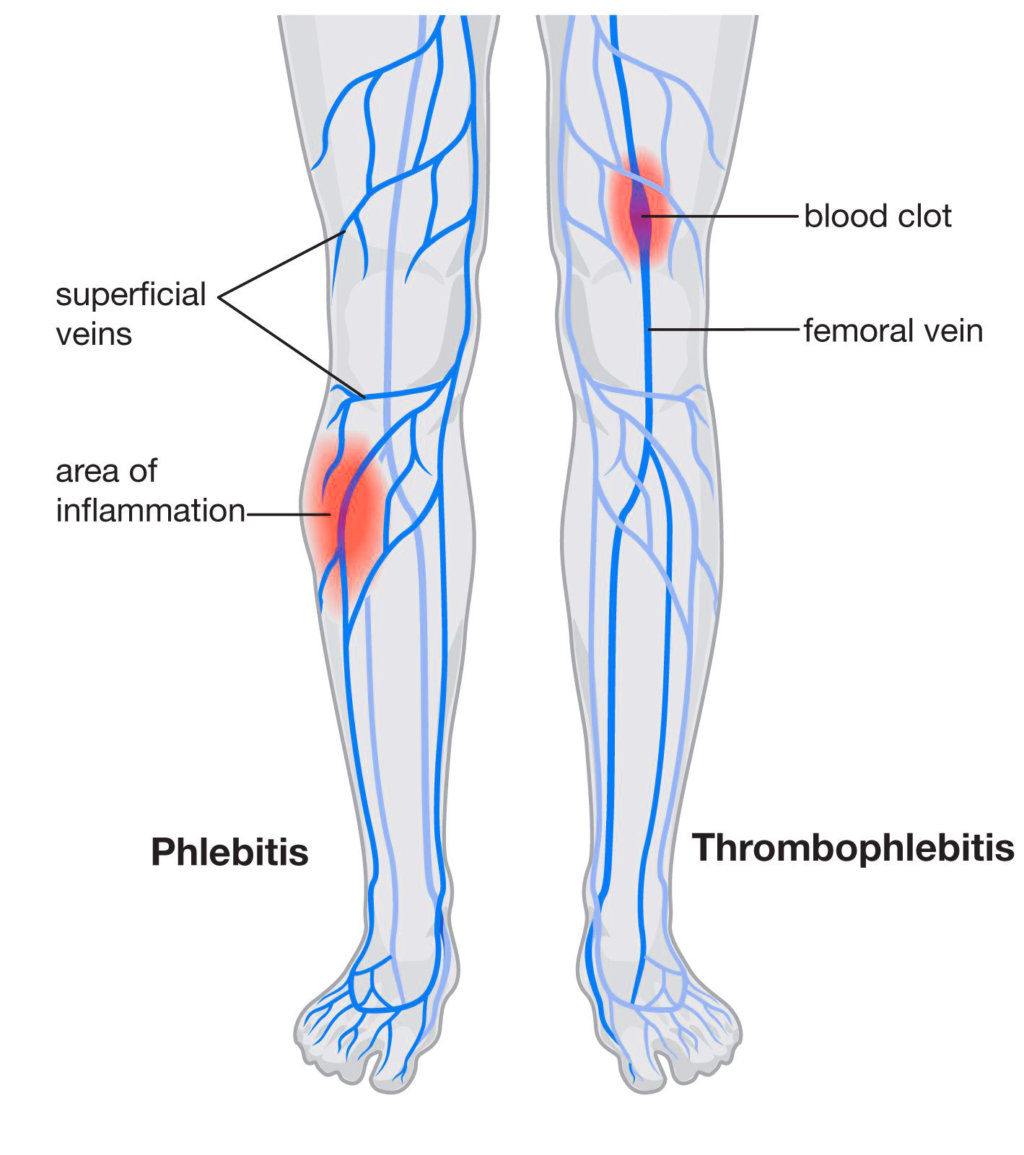 Phlebitis and Blood Clots - Preferred Vascular Group