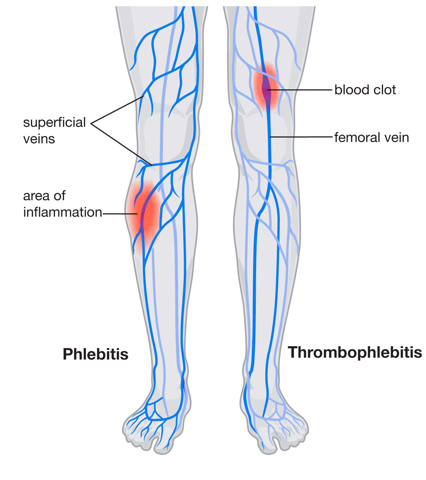 blood clot in upper leg