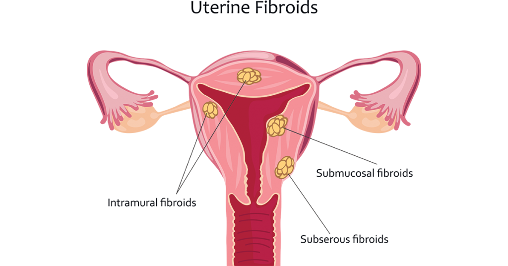 diagram of types of uterine fibroids; blog: What to Expect If You Have Uterine Fibroids