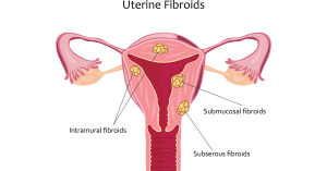 diagram of types of uterine fibroids; blog: What to Expect If You Have Uterine Fibroids