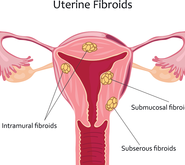 diagram of types of uterine fibroids; blog: What to Expect If You Have Uterine Fibroids