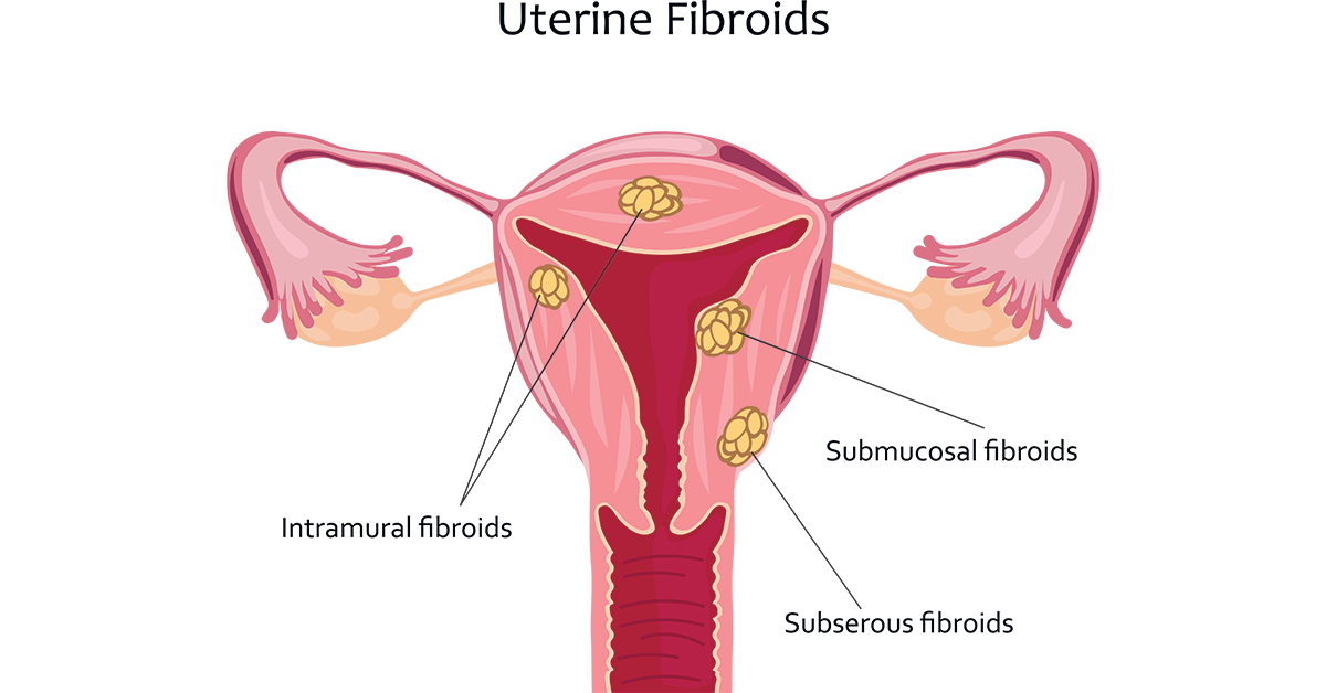 Fibras uterinas