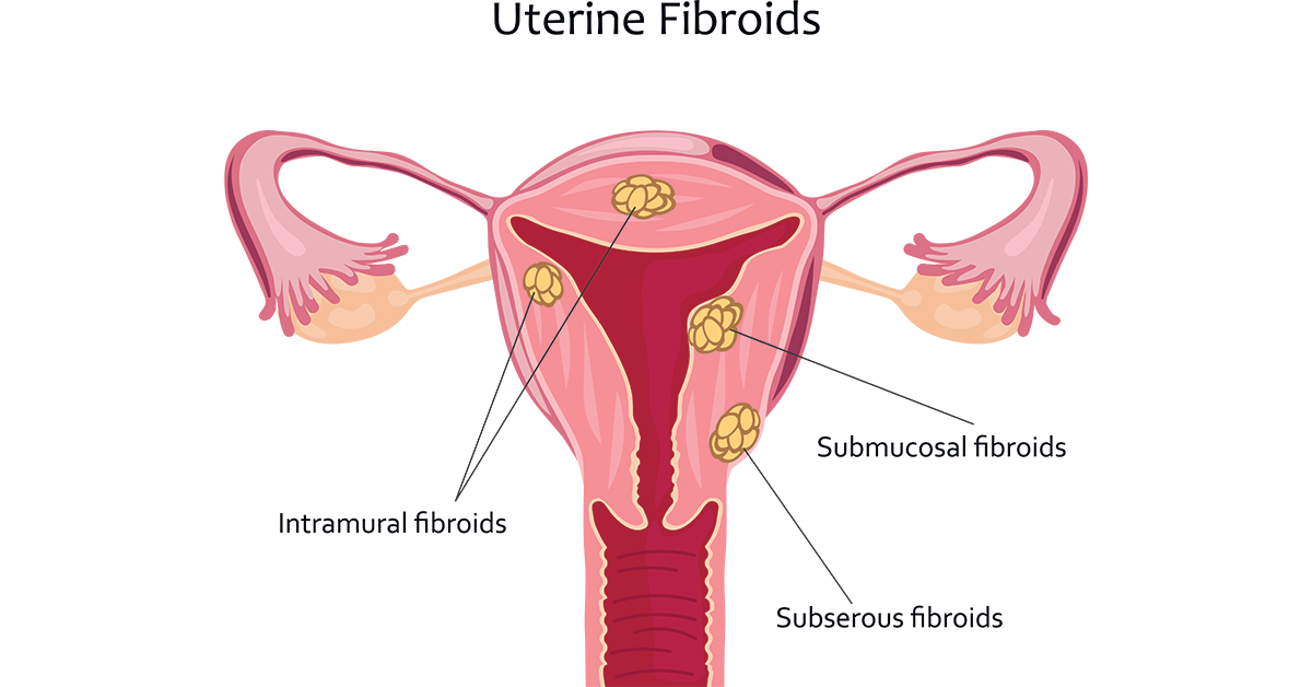 Kohdun fibroidit